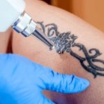 how does laser tattoo removal work