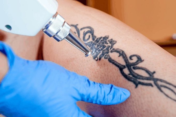 how does laser tattoo removal work