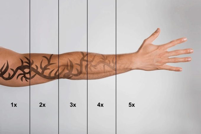 how effective is tattoo removal