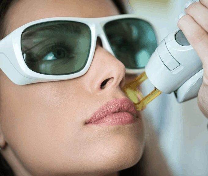 how long does laser hair removal last