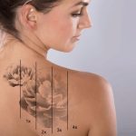 how much does laser tattoo removal cost