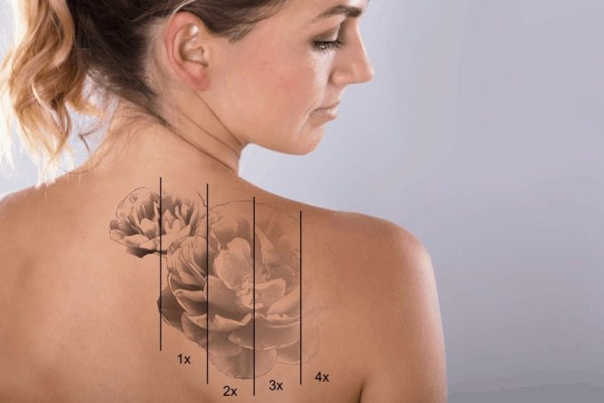 how much does laser tattoo removal cost