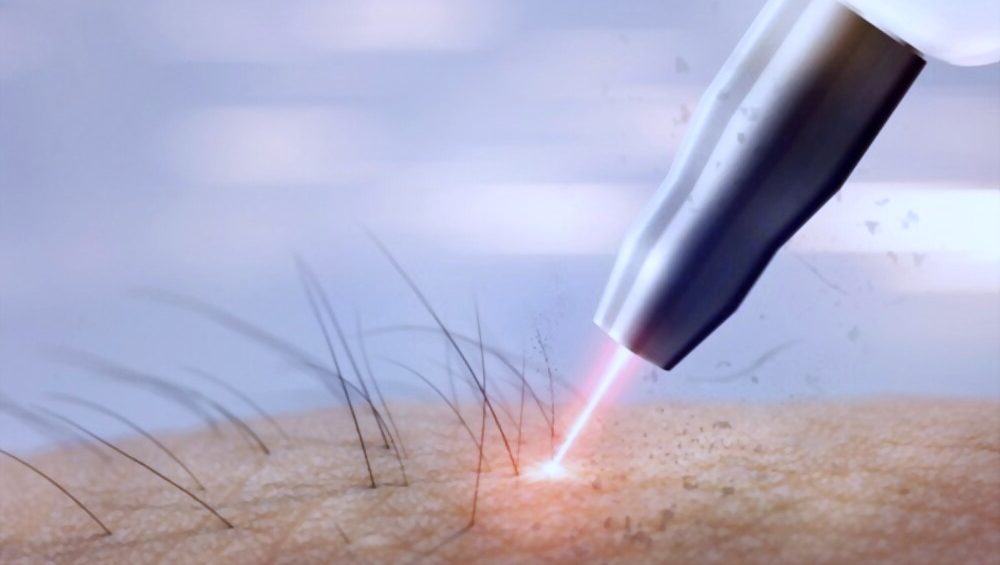 List Of Best Laser Treatment For Tattoo Removal in Trichy - Best Tattoo  Removal Clinics - Justdial