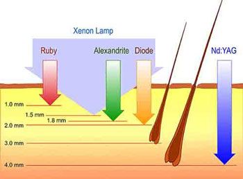 Como Funciona o Laser Alexandrite?